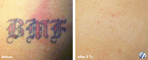 Rapid Laser Tattoo Removal Before & After Results Salinas and Monterey
