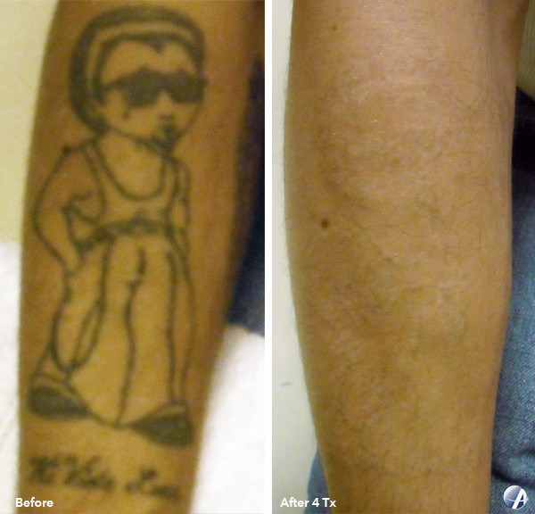 Rapid Laser Tattoo Removal Before & After Results Salinas and Monterey