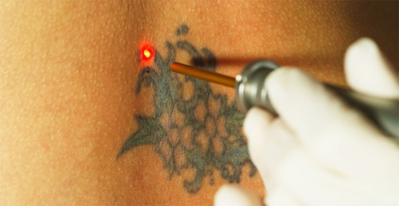 Rapid Laser Tattoo Removal